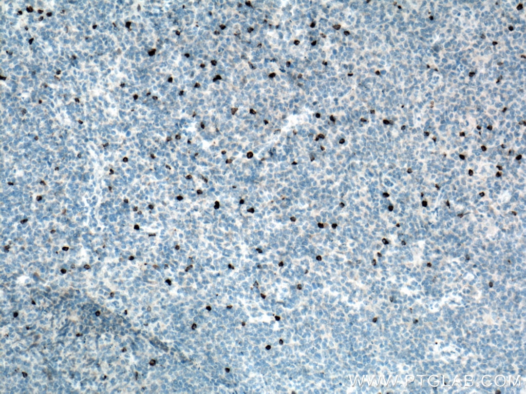 Immunohistochemistry (IHC) staining of human tonsillitis tissue using LAG-3 Polyclonal antibody (16616-1-AP)