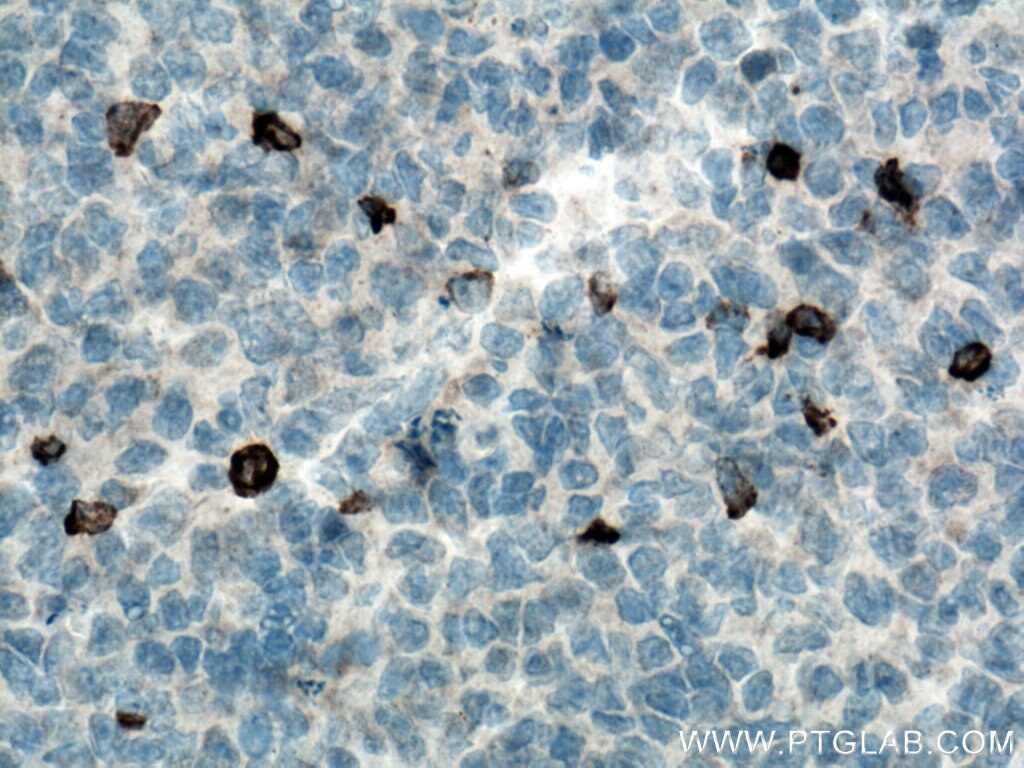 Immunohistochemistry (IHC) staining of human tonsillitis tissue using LAG-3 Polyclonal antibody (16616-1-AP)