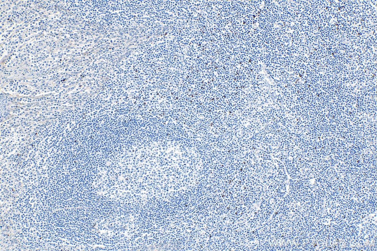 Immunohistochemistry (IHC) staining of human tonsillitis tissue using LAG-3 Polyclonal antibody (29548-1-AP)