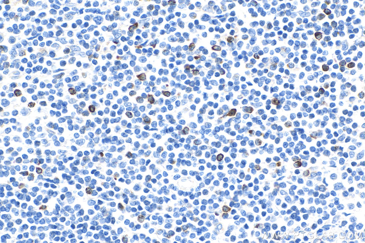 Immunohistochemistry (IHC) staining of human tonsillitis tissue using LAG-3 Polyclonal antibody (29548-1-AP)