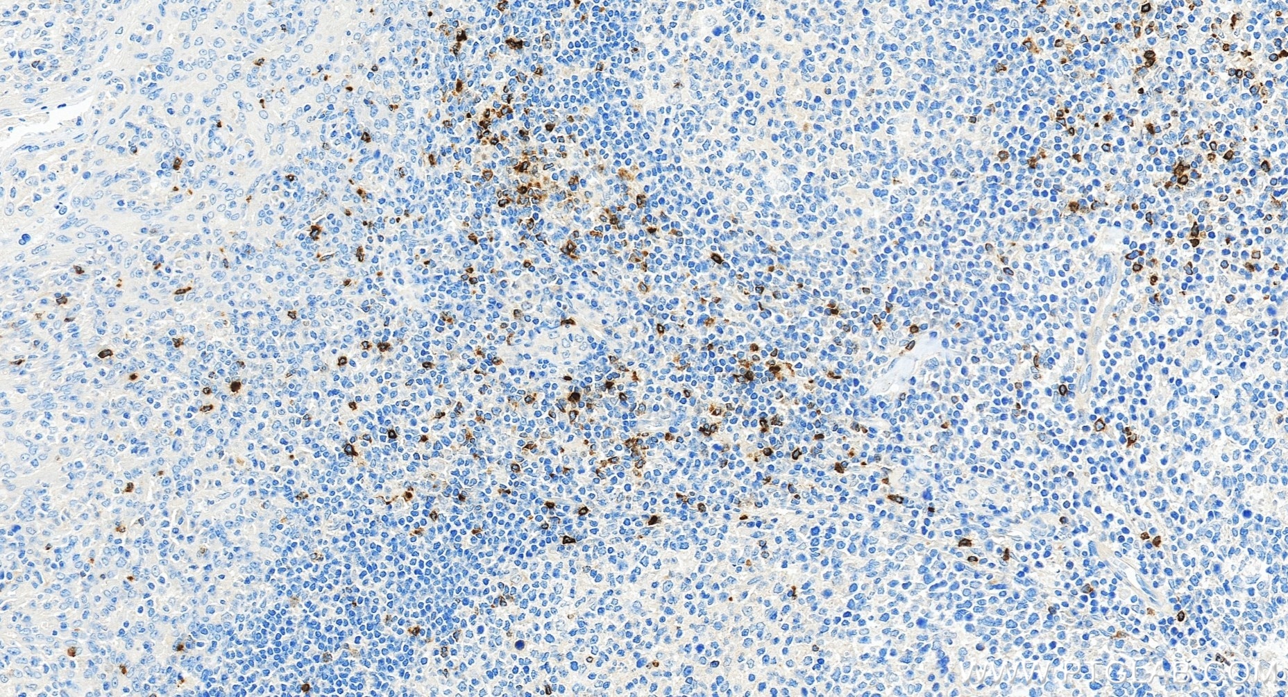 IHC staining of human tonsillitis using 98435-3-RR Immunohistochemistry (IHC) staining of human tonsillitis tissue using Anti-Human LAG-3/CD223 Rabbit Recombinant Antibody (98435-3-RR)