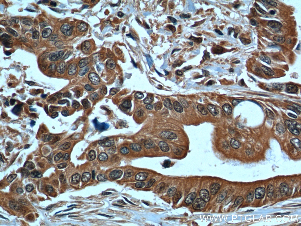 Immunohistochemistry (IHC) staining of human pancreas cancer tissue using CD107b / LAMP2 Polyclonal antibody (10397-1-AP)