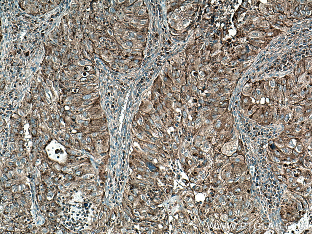 Immunohistochemistry (IHC) staining of human lung cancer tissue using CD107b / LAMP2 Polyclonal antibody (27823-1-AP)