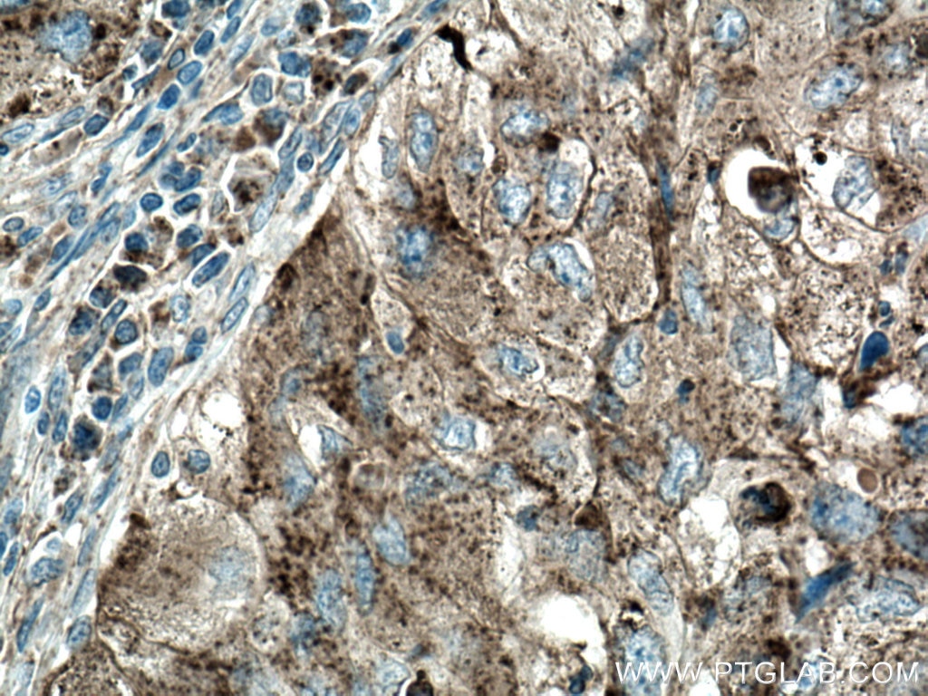 Immunohistochemistry (IHC) staining of human lung cancer tissue using CD107b / LAMP2 Polyclonal antibody (27823-1-AP)