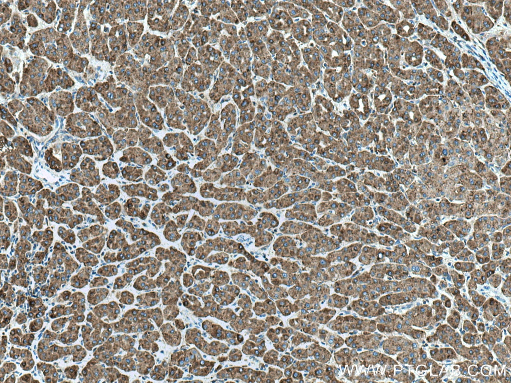 Immunohistochemistry (IHC) staining of human liver cancer tissue using CD107b / LAMP2 Monoclonal antibody (66301-1-Ig)