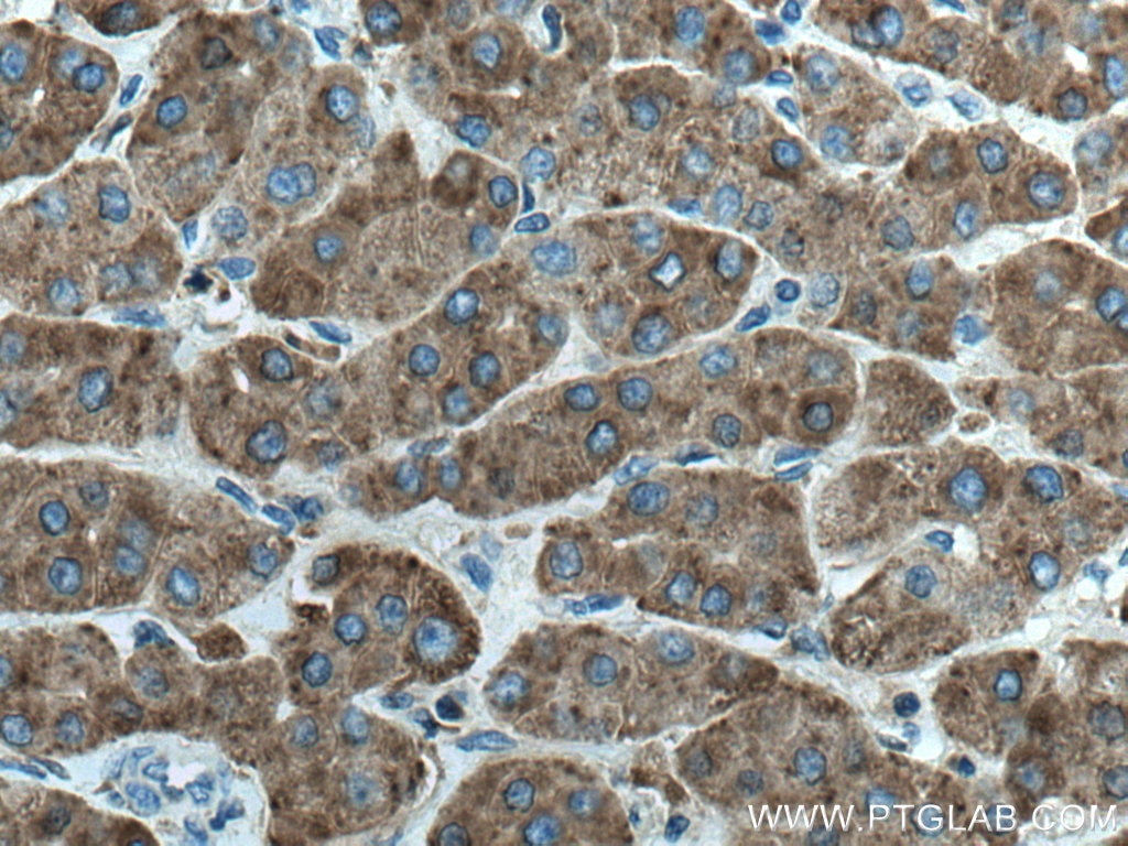 Immunohistochemistry (IHC) staining of human liver cancer tissue using CD107b / LAMP2 Monoclonal antibody (66301-1-Ig)