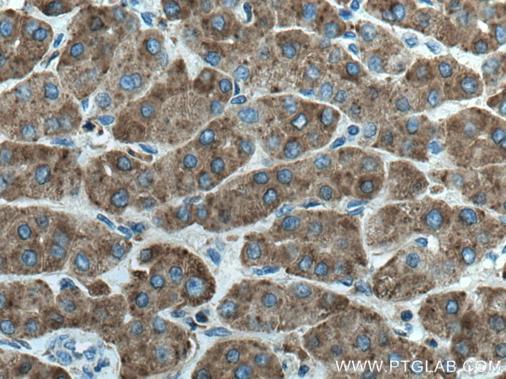 IHC staining of human liver cancer using 66301-1-Ig