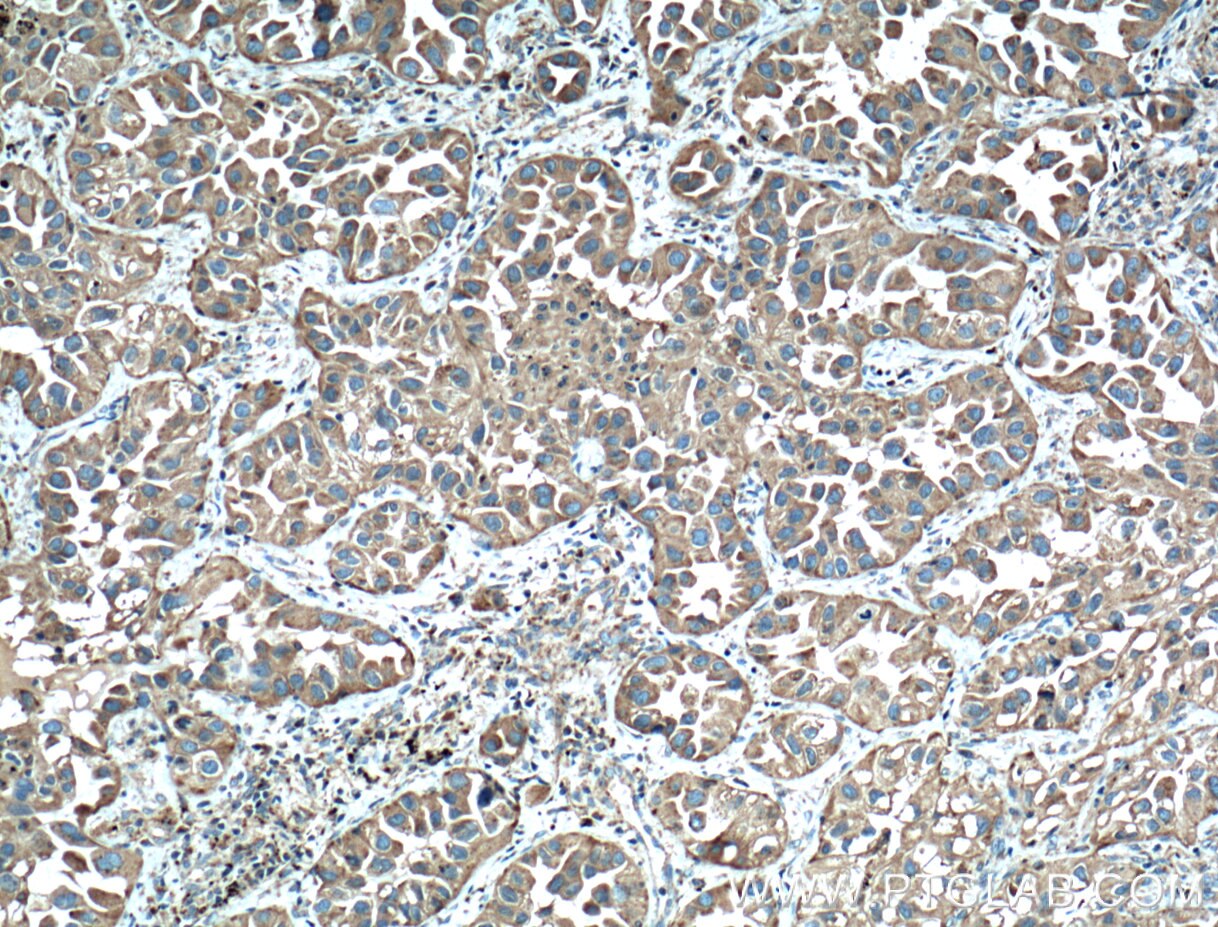 Immunohistochemistry (IHC) staining of human lung cancer tissue using CD107b / LAMP2 Monoclonal antibody (66301-1-Ig)
