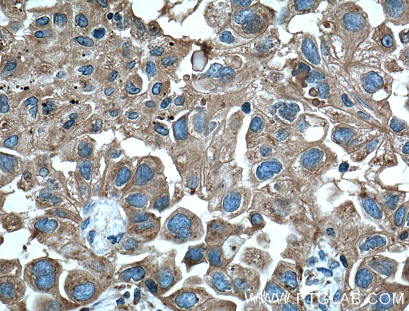 Immunohistochemistry (IHC) staining of human lung cancer tissue using CD107b / LAMP2 Monoclonal antibody (66301-1-Ig)