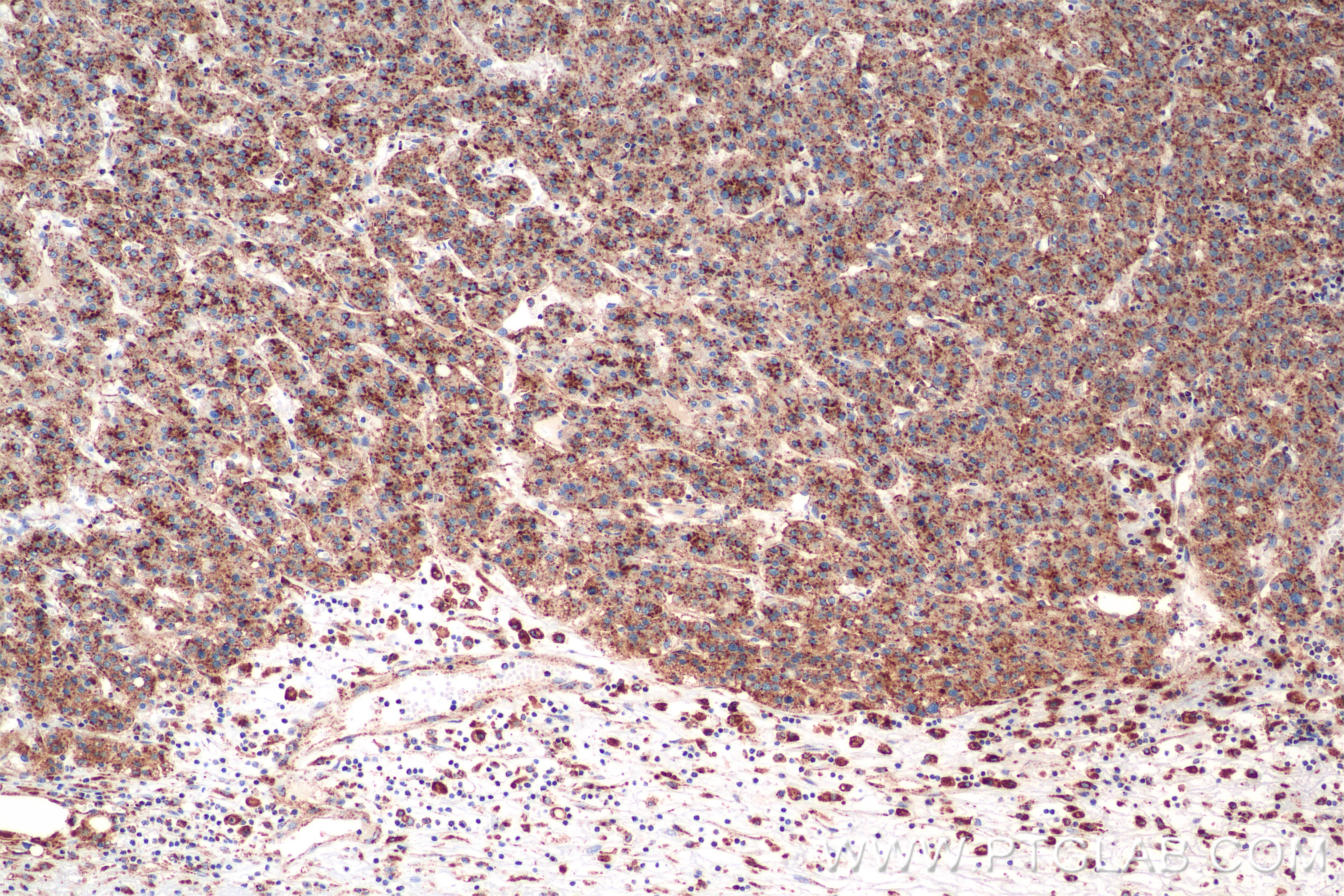Immunohistochemistry (IHC) staining of human hepatocellular cancer using CD107b / LAMP2 Recombinant antibody (86269-3-RR)