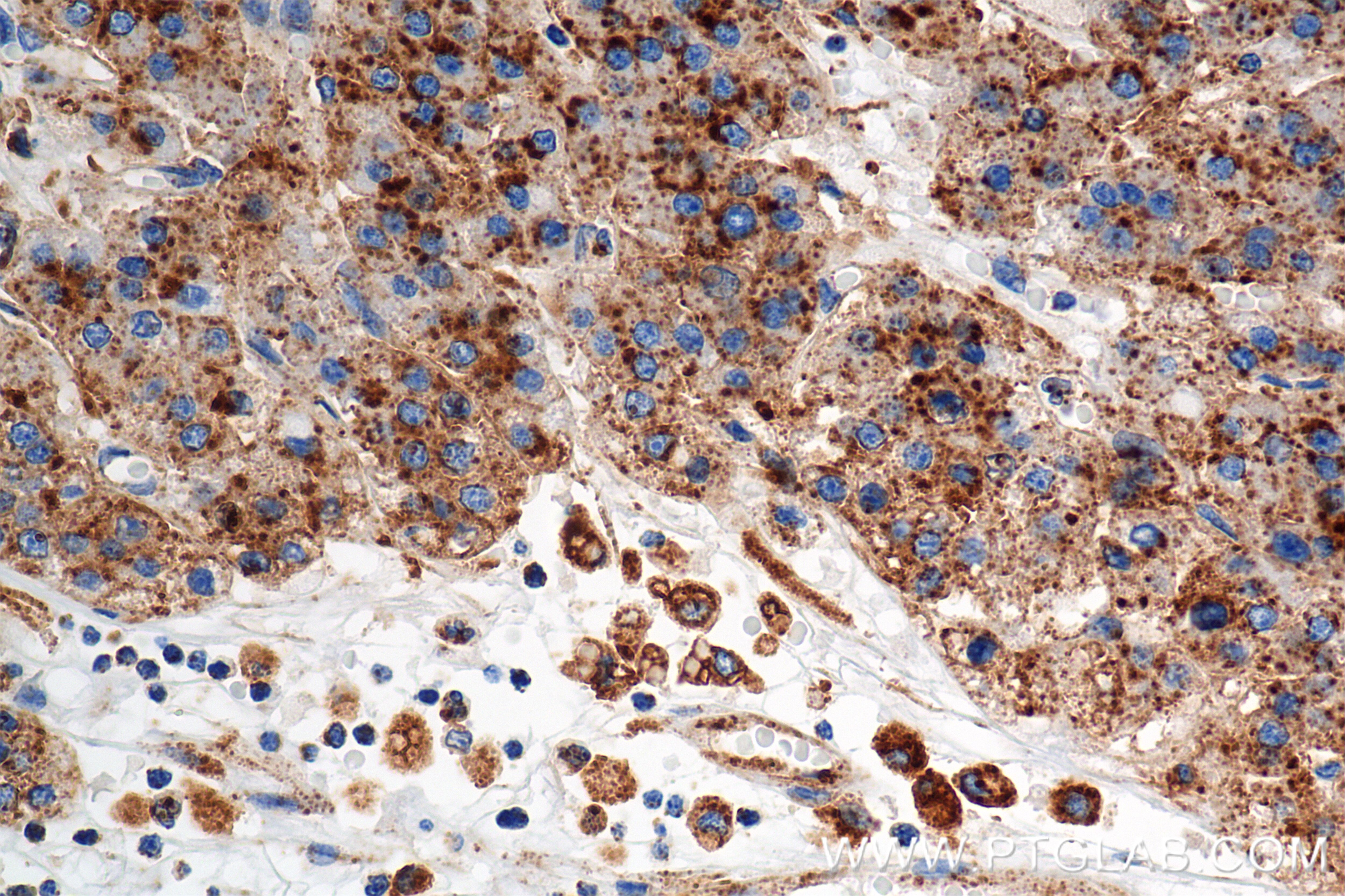 Immunohistochemistry (IHC) staining of human hepatocellular cancer using CD107b / LAMP2 Recombinant antibody (86269-3-RR)