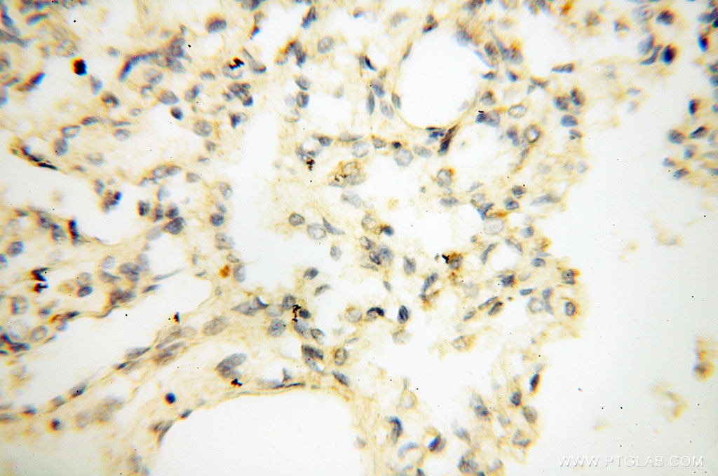 Immunohistochemistry (IHC) staining of human lung tissue using LAMP3 Polyclonal antibody (12632-1-AP)