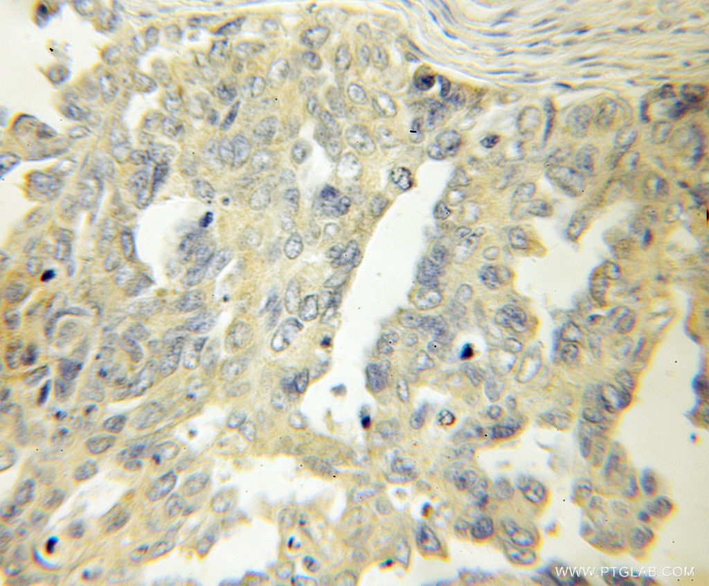 Immunohistochemistry (IHC) staining of human ovary tumor tissue using LAMR1,RPSA Polyclonal antibody (10668-1-AP)