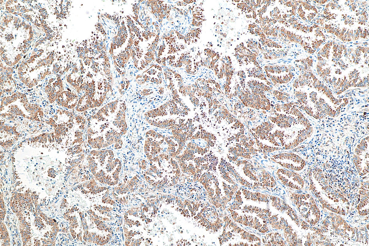 Immunohistochemistry (IHC) staining of human lung cancer tissue using LAMR1,RPSA Monoclonal antibody (67324-1-Ig)