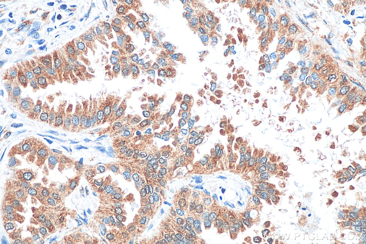 Immunohistochemistry (IHC) staining of human lung cancer tissue using LAMR1,RPSA Monoclonal antibody (67324-1-Ig)