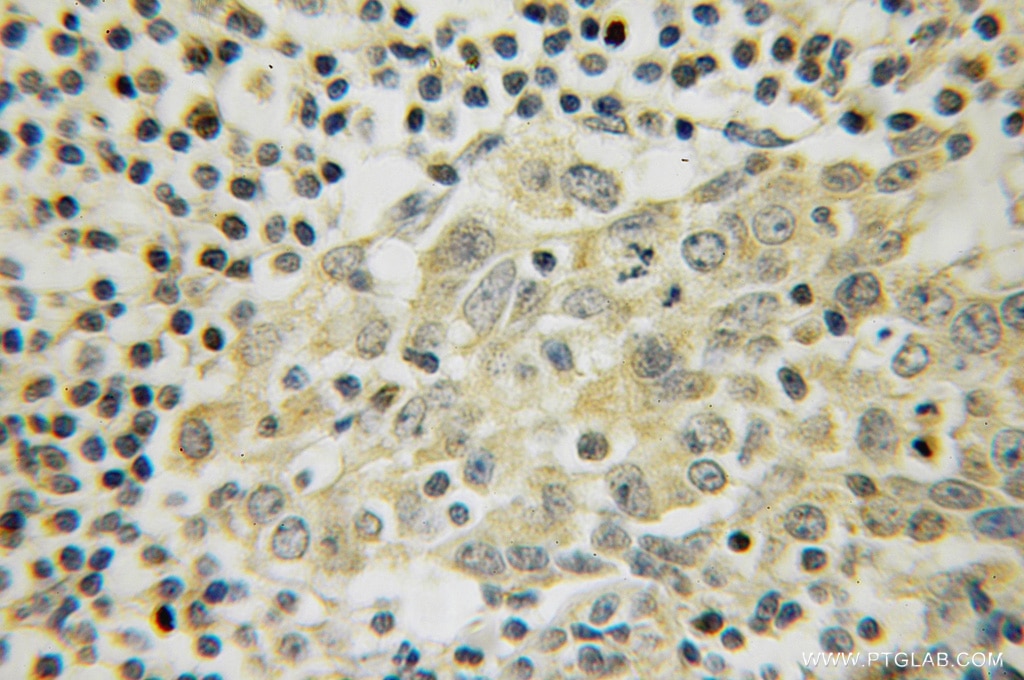 Immunohistochemistry (IHC) staining of human breast cancer tissue using LANCL1 Polyclonal antibody (12647-1-AP)