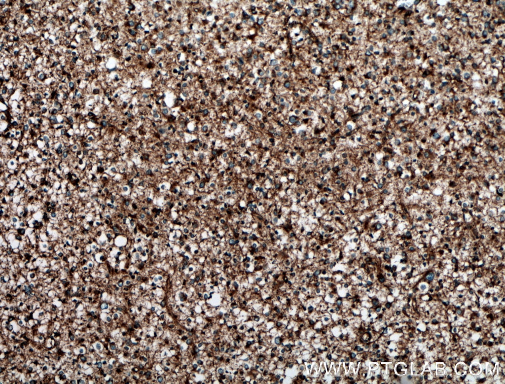 Immunohistochemistry (IHC) staining of human gliomas tissue using LAP3 Polyclonal antibody (14612-1-AP)