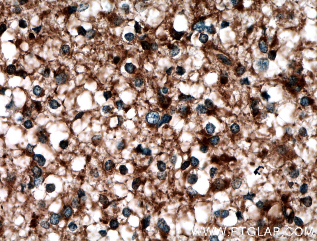Immunohistochemistry (IHC) staining of human gliomas tissue using LAP3 Polyclonal antibody (14612-1-AP)