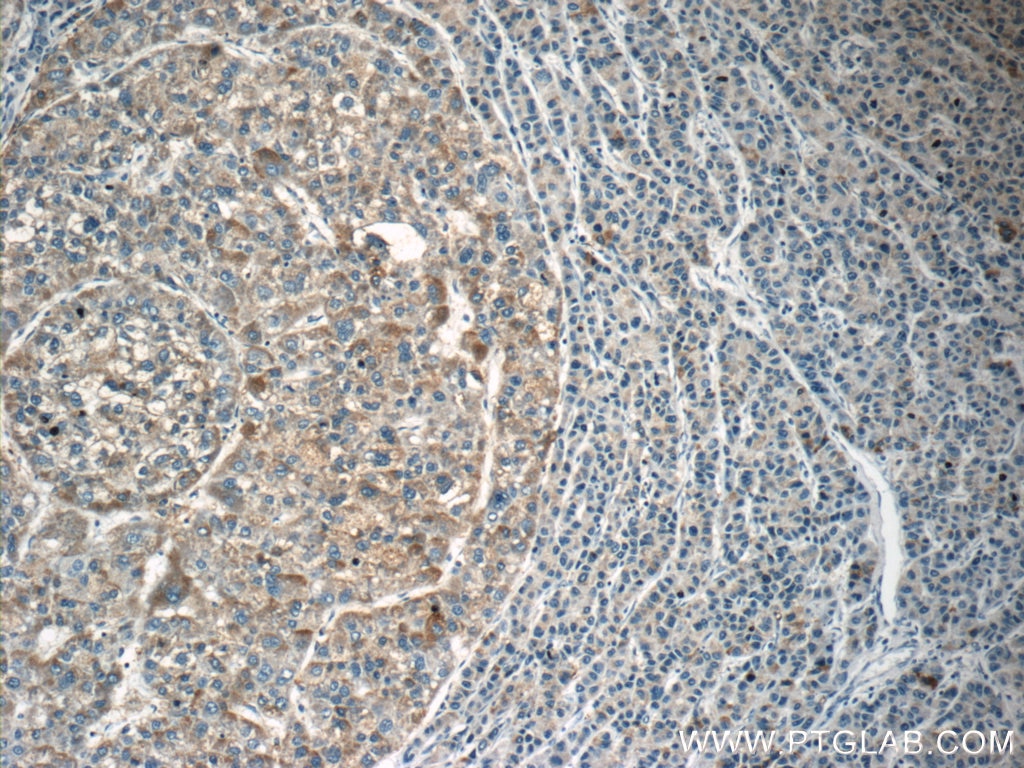 Immunohistochemistry (IHC) staining of human liver cancer tissue using LAPTM4B Polyclonal antibody (18895-1-AP)