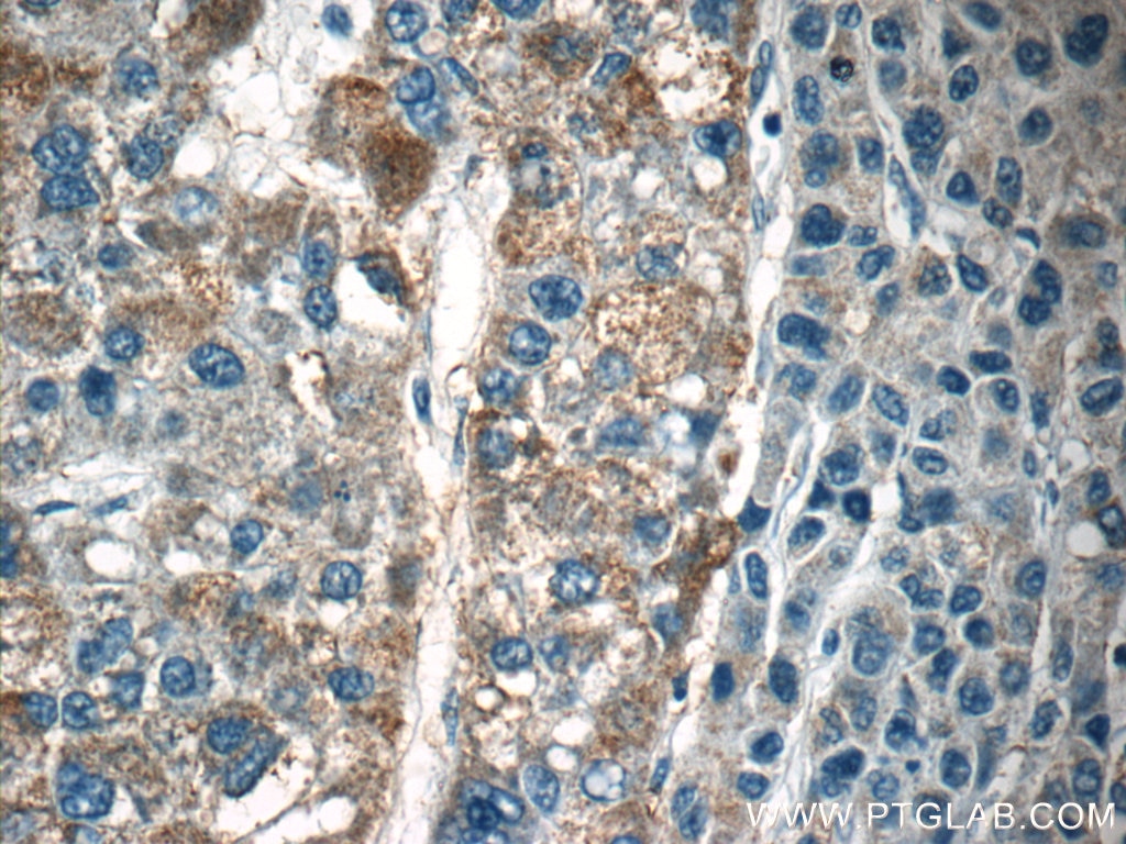 Immunohistochemistry (IHC) staining of human liver cancer tissue using LAPTM4B Polyclonal antibody (18895-1-AP)