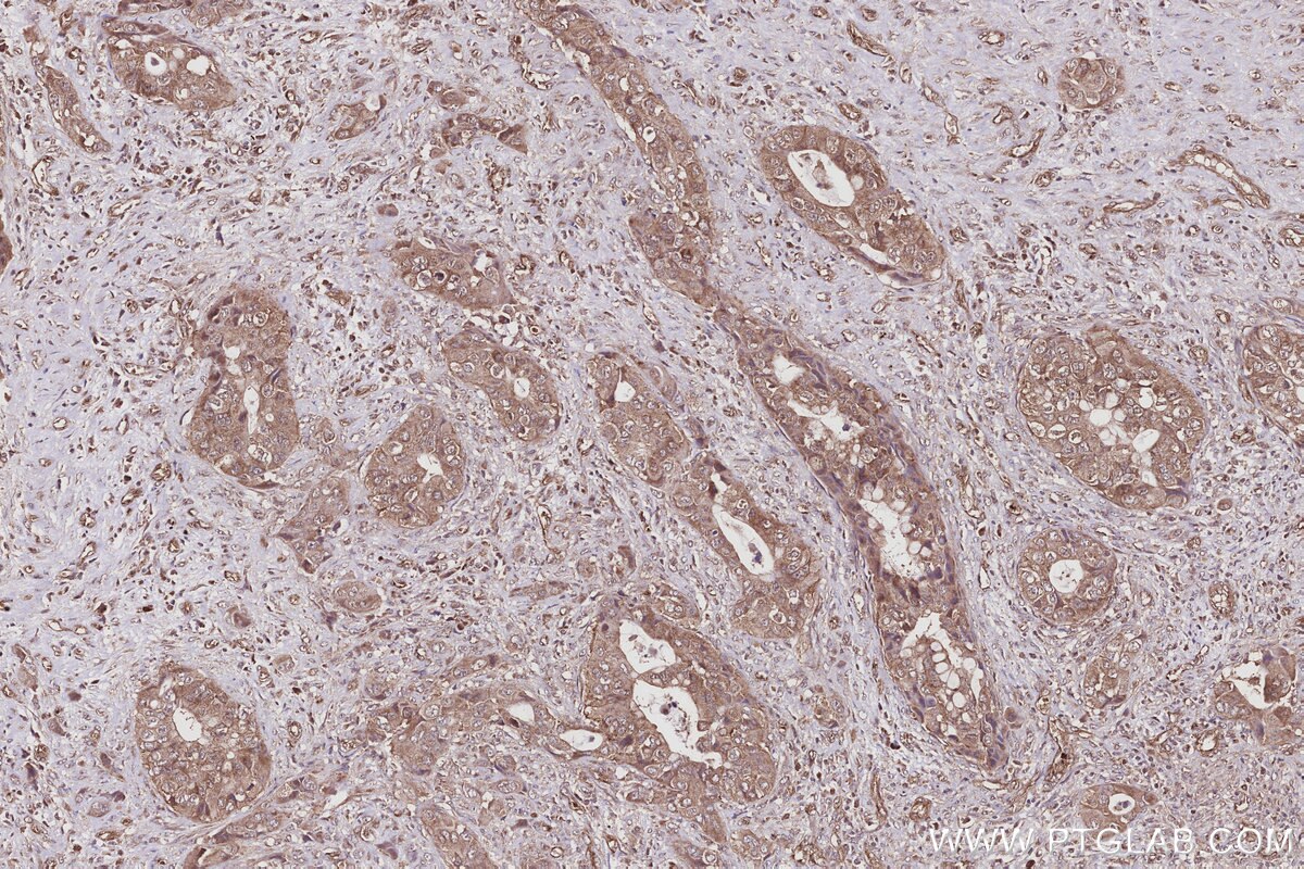 IHC staining of human pancreas cancer using 22441-1-AP Immunohistochemistry (IHC) staining of human pancreas cancer tissue using LARG Polyclonal antibody (22441-1-AP)