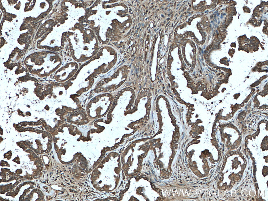 IHC staining of human ovary tumor using 13708-1-AP