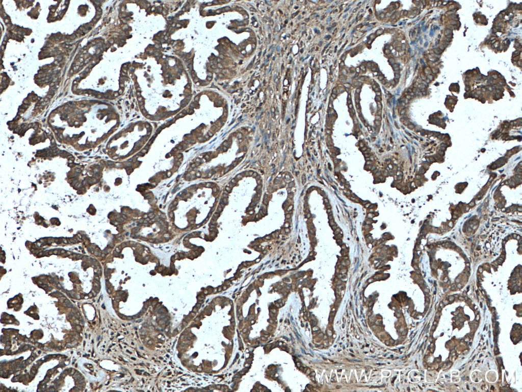 Immunohistochemistry (IHC) staining of human ovary tumor tissue using LARP1 Polyclonal antibody (13708-1-AP)