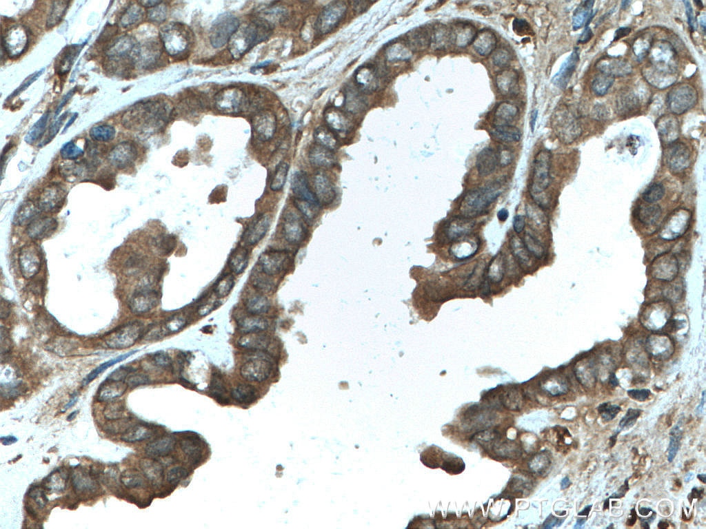 Immunohistochemistry (IHC) staining of human ovary tumor tissue using LARP1 Polyclonal antibody (13708-1-AP)