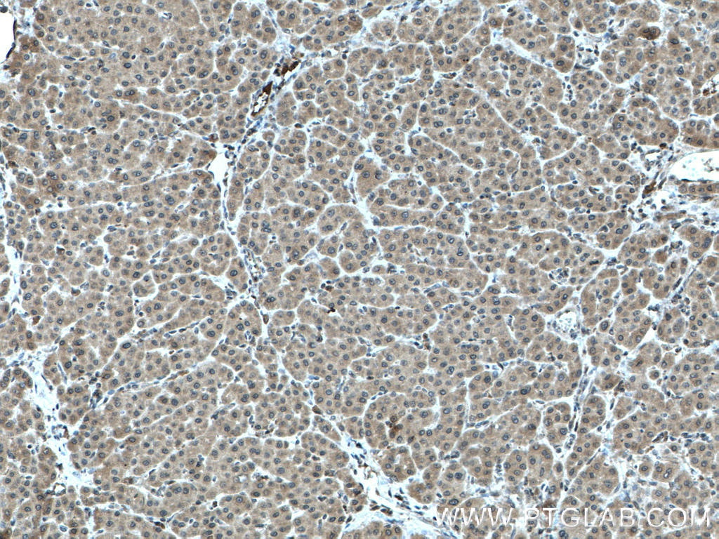 Immunohistochemistry (IHC) staining of human liver cancer tissue using LARP1 Polyclonal antibody (13708-1-AP)