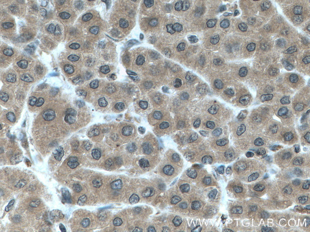 Immunohistochemistry (IHC) staining of human liver cancer tissue using LARP1 Polyclonal antibody (13708-1-AP)