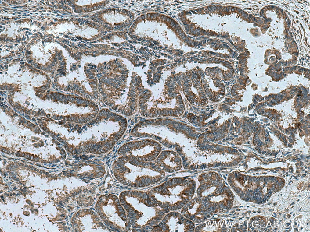 Immunohistochemistry (IHC) staining of human ovary tumor tissue using LARP1 Monoclonal antibody (67810-1-Ig)