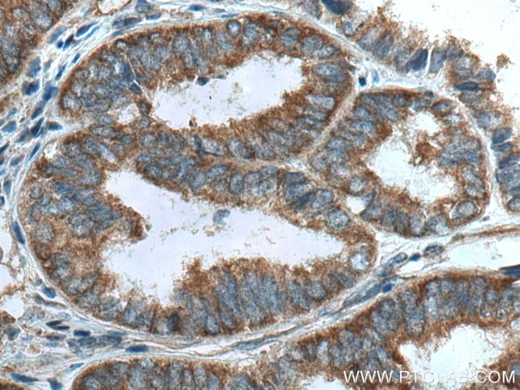 Immunohistochemistry (IHC) staining of human ovary tumor tissue using LARP1 Monoclonal antibody (67810-1-Ig)