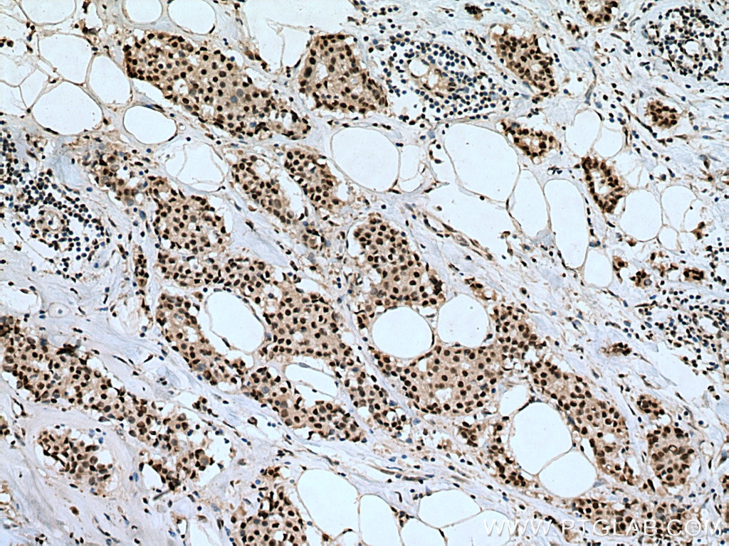 IHC staining of human breast cancer using 17067-1-AP