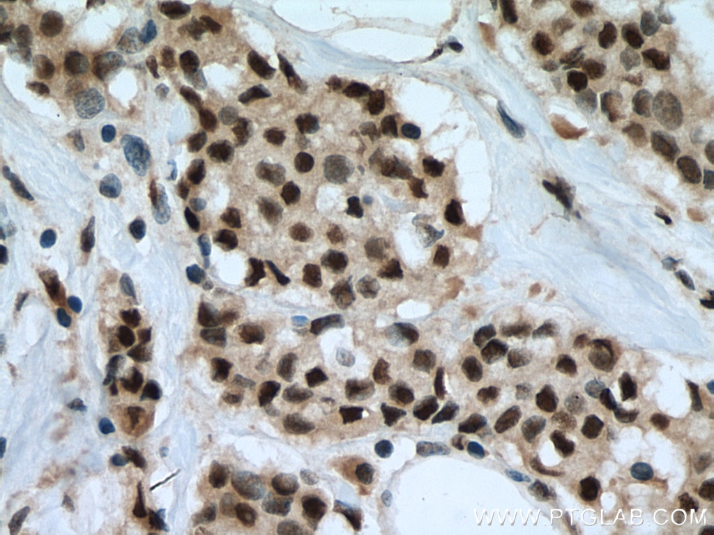 Immunohistochemistry (IHC) staining of human breast cancer tissue using LARP7 Polyclonal antibody (17067-1-AP)