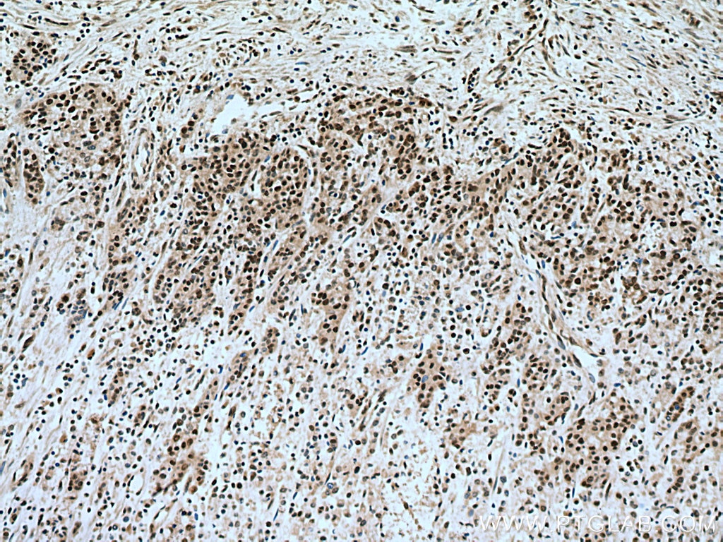 Immunohistochemistry (IHC) staining of human stomach cancer tissue using LARP7 Polyclonal antibody (17067-1-AP)