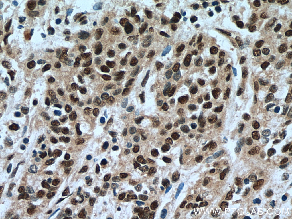 Immunohistochemistry (IHC) staining of human stomach cancer tissue using LARP7 Polyclonal antibody (17067-1-AP)