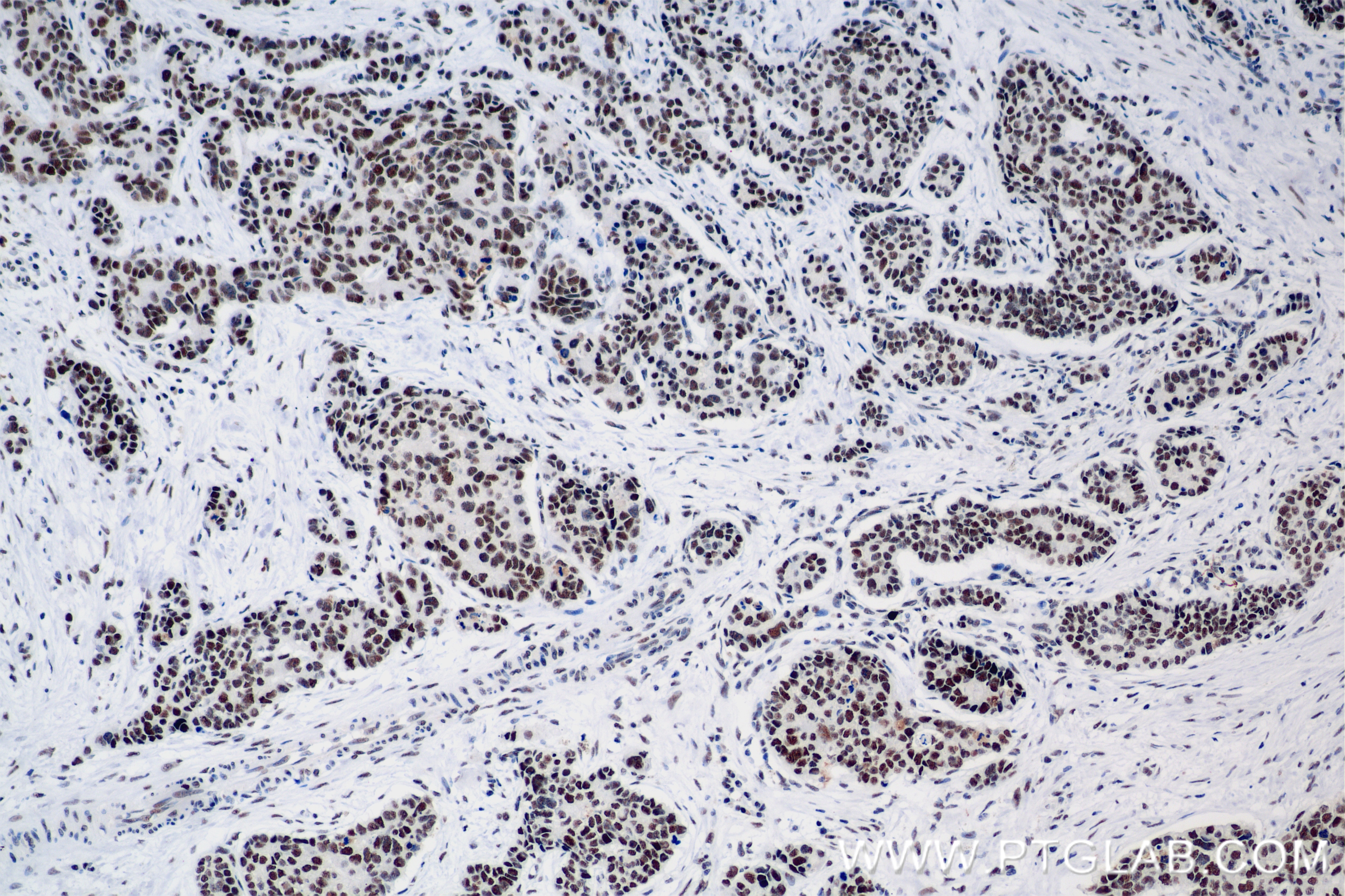 Immunohistochemistry (IHC) staining of human stomach cancer tissue using LARP7 Recombinant antibody (84950-3-RR)