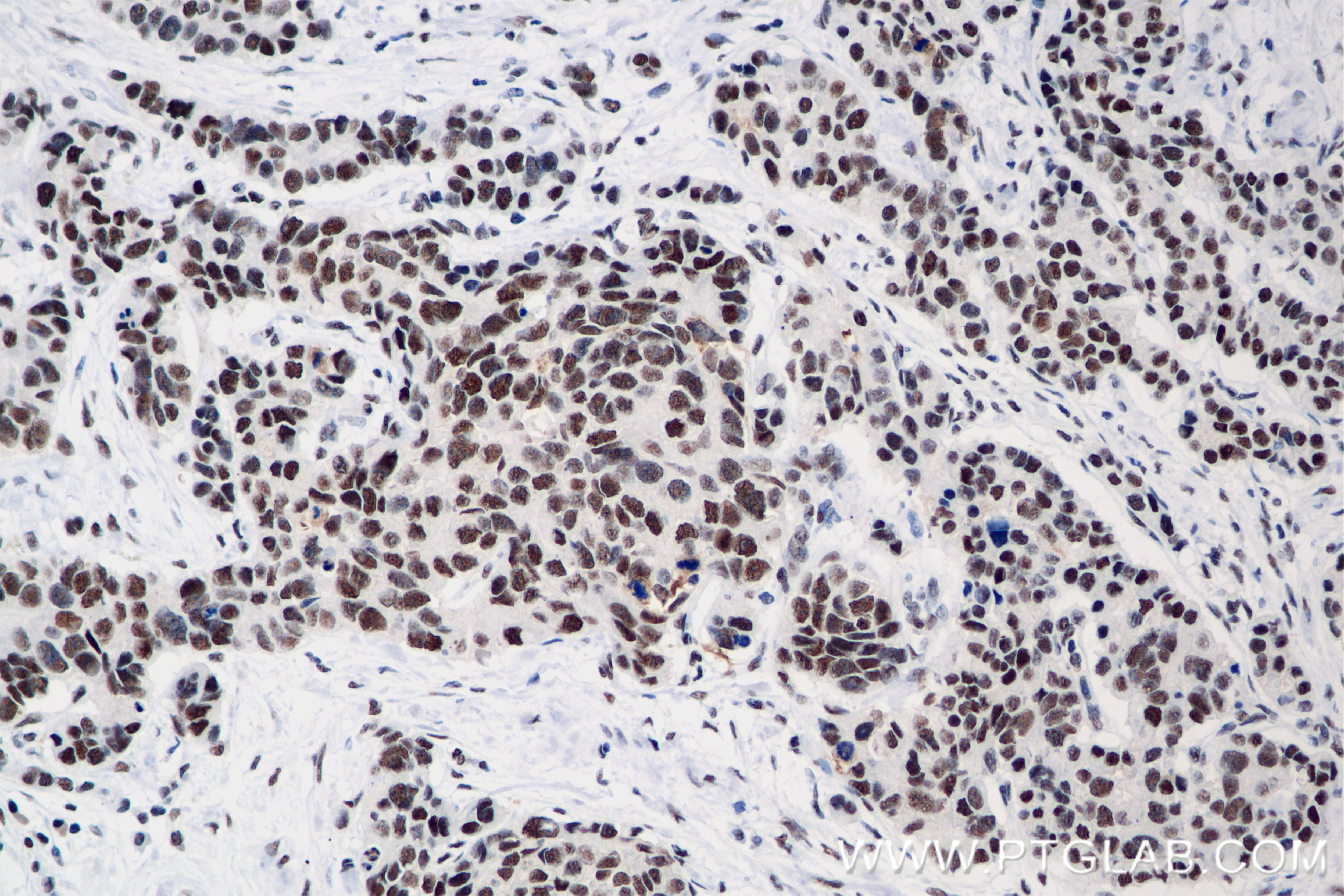 Immunohistochemistry (IHC) staining of human stomach cancer tissue using LARP7 Recombinant antibody (84950-3-RR)