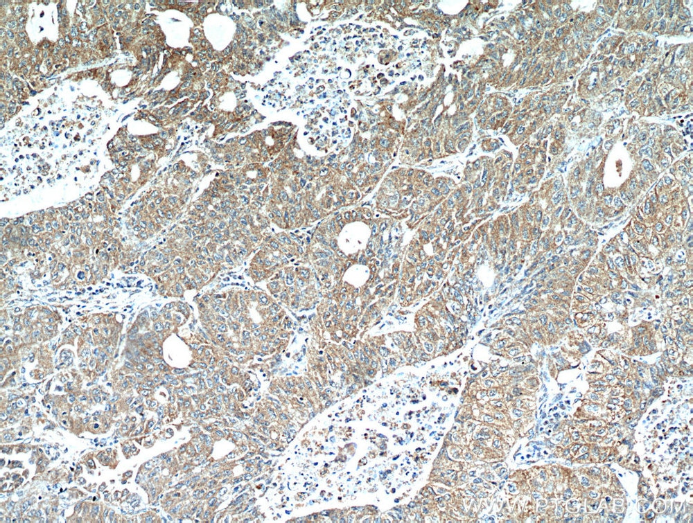 IHC staining of human lung cancer using 21146-1-AP