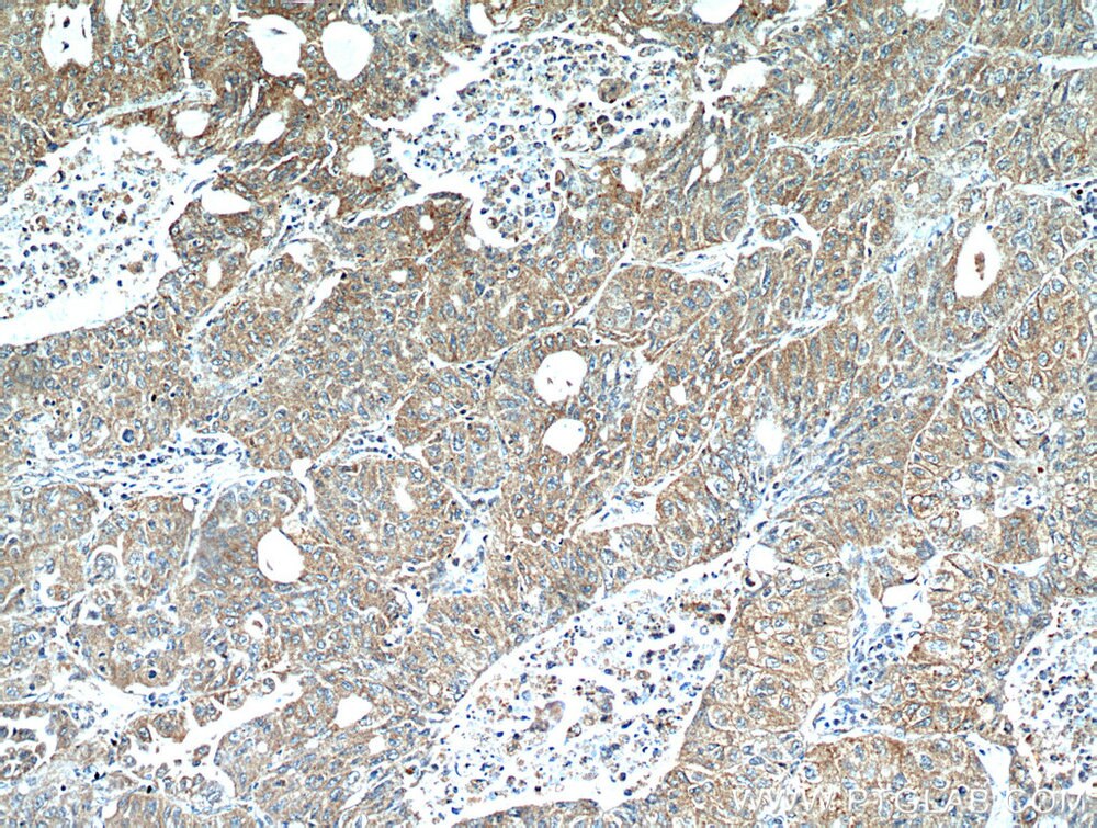 Immunohistochemistry (IHC) staining of human lung cancer tissue using LARS Polyclonal antibody (21146-1-AP)