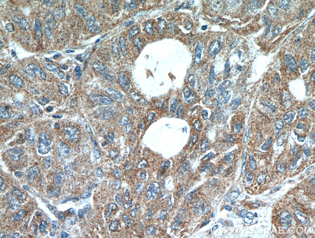 Immunohistochemistry (IHC) staining of human lung cancer tissue using LARS Polyclonal antibody (21146-1-AP)