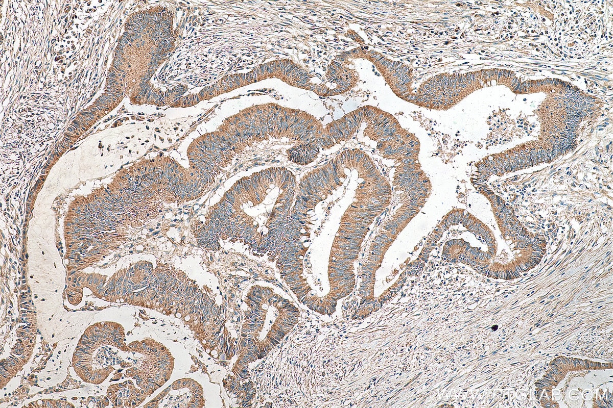 Immunohistochemistry (IHC) staining of human colon cancer tissue using LARS2 Polyclonal antibody (17097-1-AP)