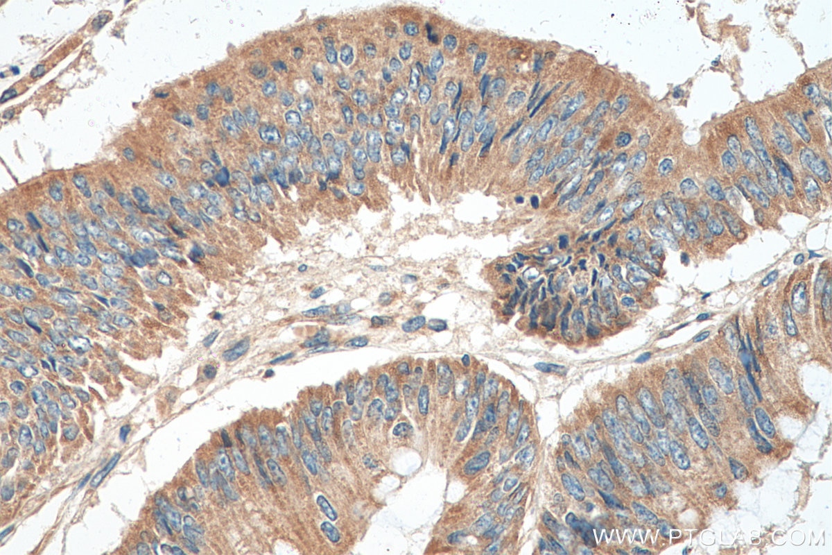Immunohistochemistry (IHC) staining of human colon cancer tissue using LARS2 Polyclonal antibody (17097-1-AP)