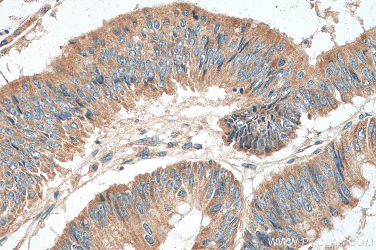 IHC staining of human colon cancer using 17097-1-AP