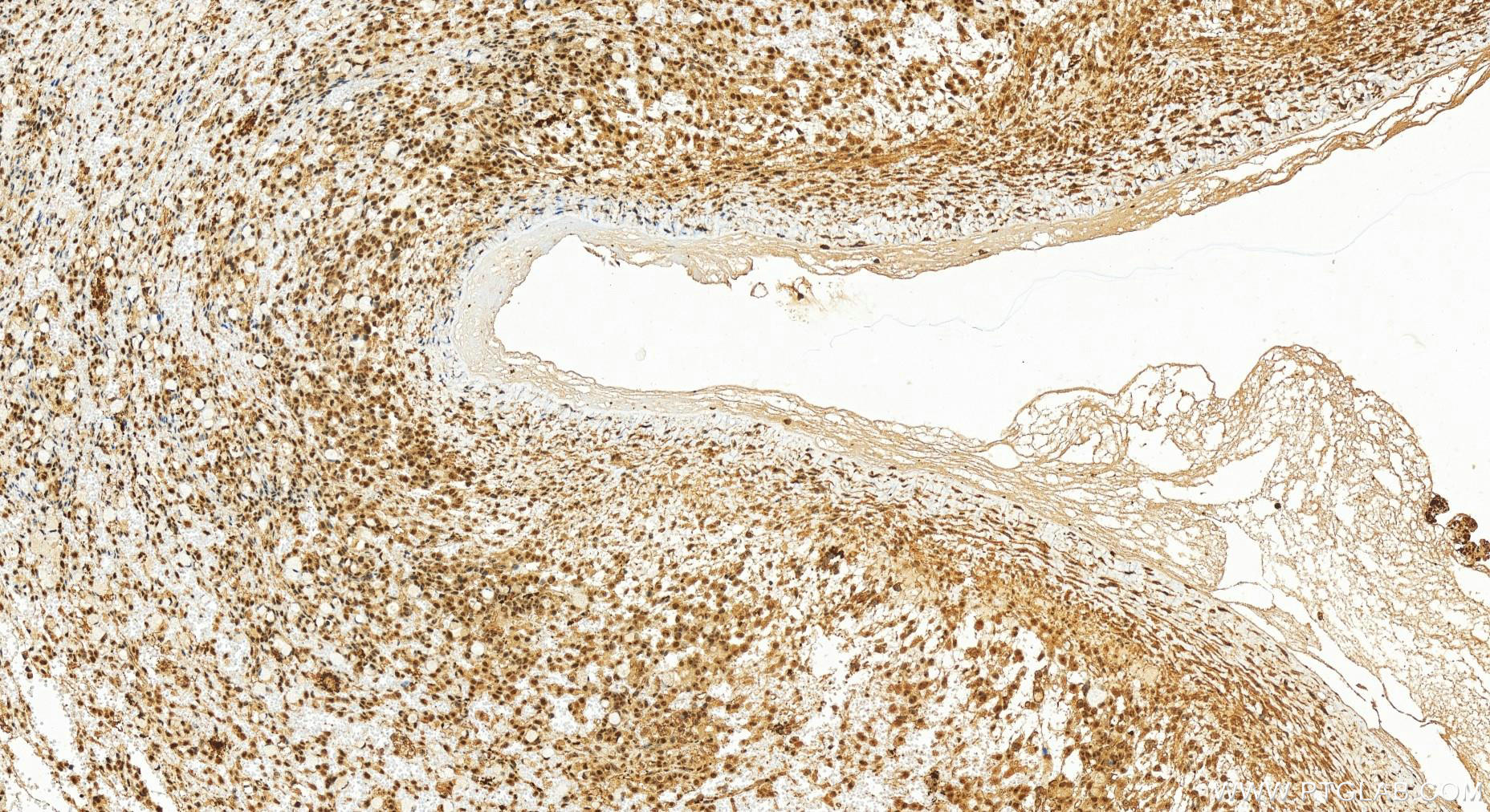 Immunohistochemistry (IHC) staining of human ovary cancer tissue using LAS1L Polyclonal antibody (16010-1-AP)