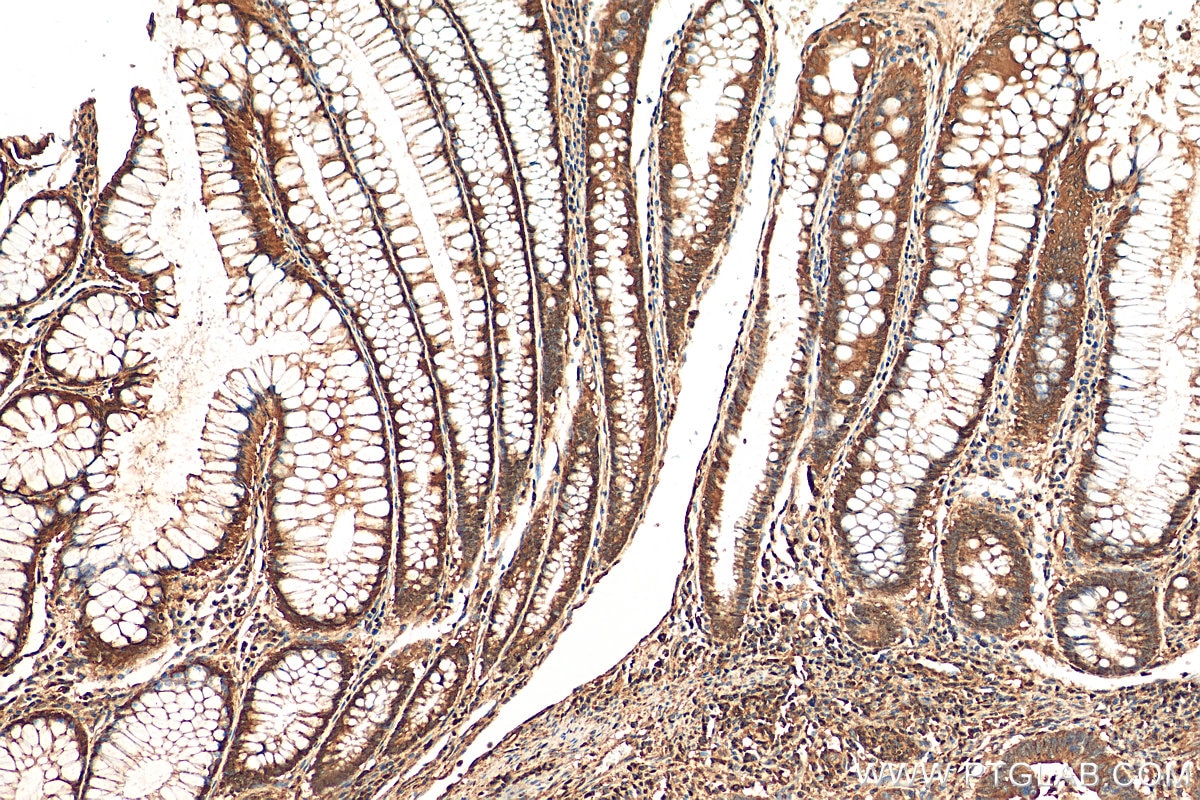 Immunohistochemistry (IHC) staining of human colon cancer tissue using LASP1 Polyclonal antibody (10515-1-AP)