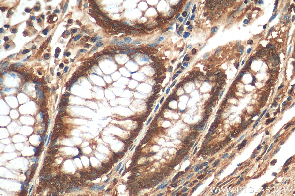 Immunohistochemistry (IHC) staining of human colon cancer tissue using LASP1 Polyclonal antibody (10515-1-AP)