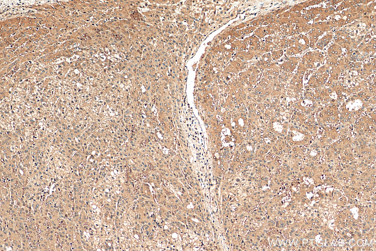 Immunohistochemistry (IHC) staining of human liver cancer tissue using LASP1 Polyclonal antibody (10515-1-AP)