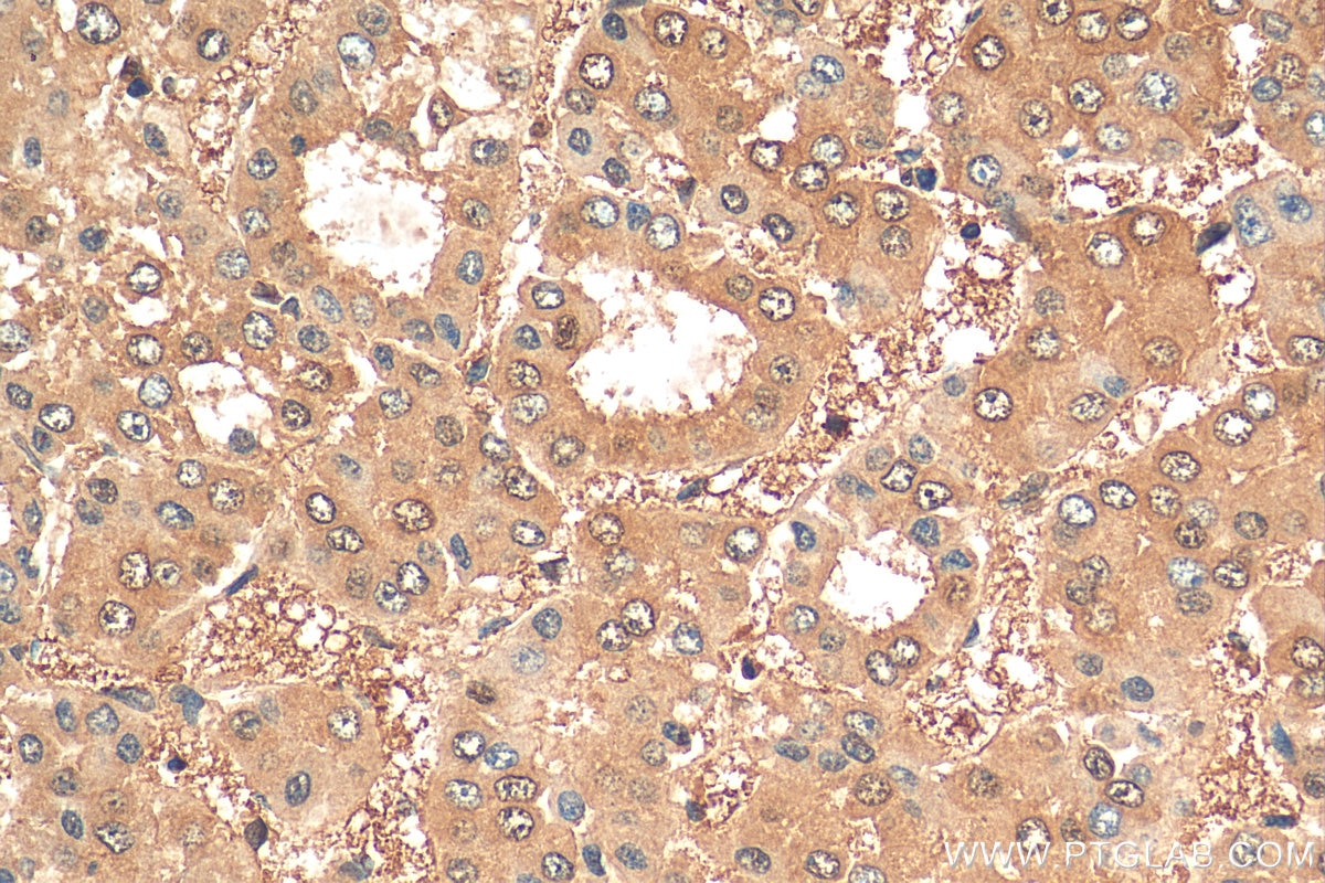 Immunohistochemistry (IHC) staining of human liver cancer tissue using LASP1 Polyclonal antibody (10515-1-AP)