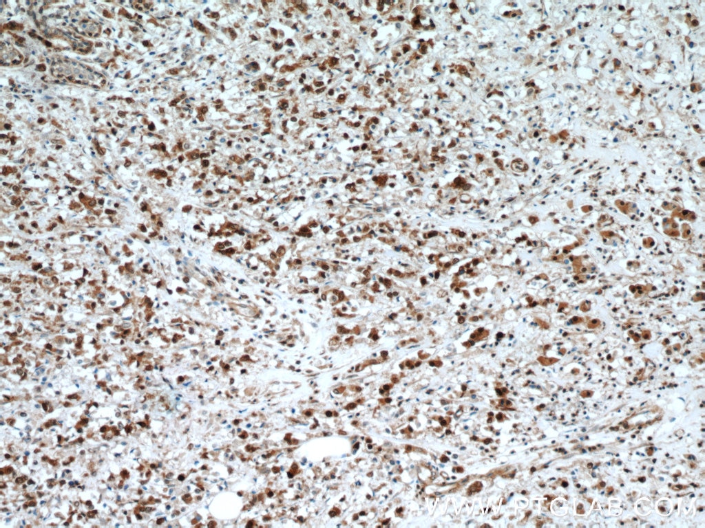 Immunohistochemistry (IHC) staining of human breast cancer tissue using LASP1 Polyclonal antibody (10515-1-AP)